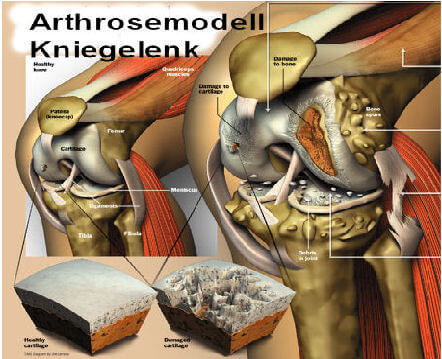 arthrose Knie Modelldarstellung
