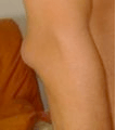 bursitis